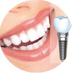 Trồng Implant