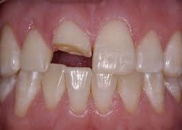 Kinh Nghiệm Trồng Răng Khi Bị Gãy Răng