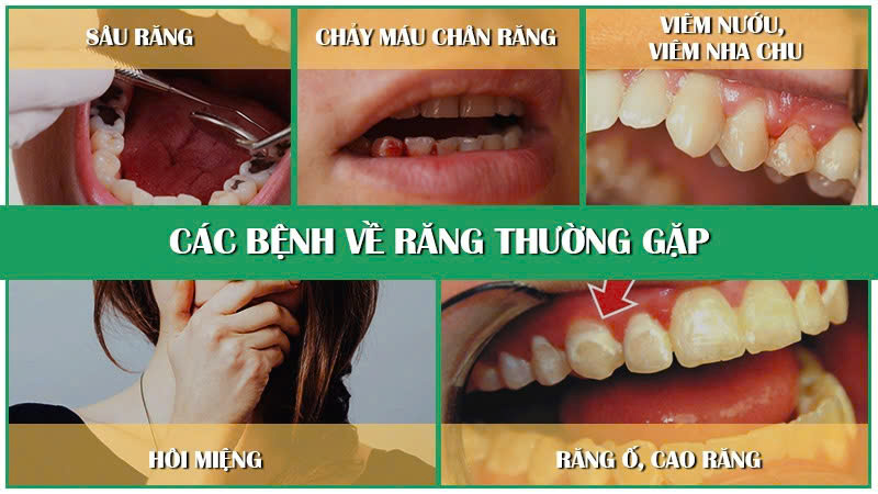 CÁC BỆNH VỀ RĂNG MIỆNG 