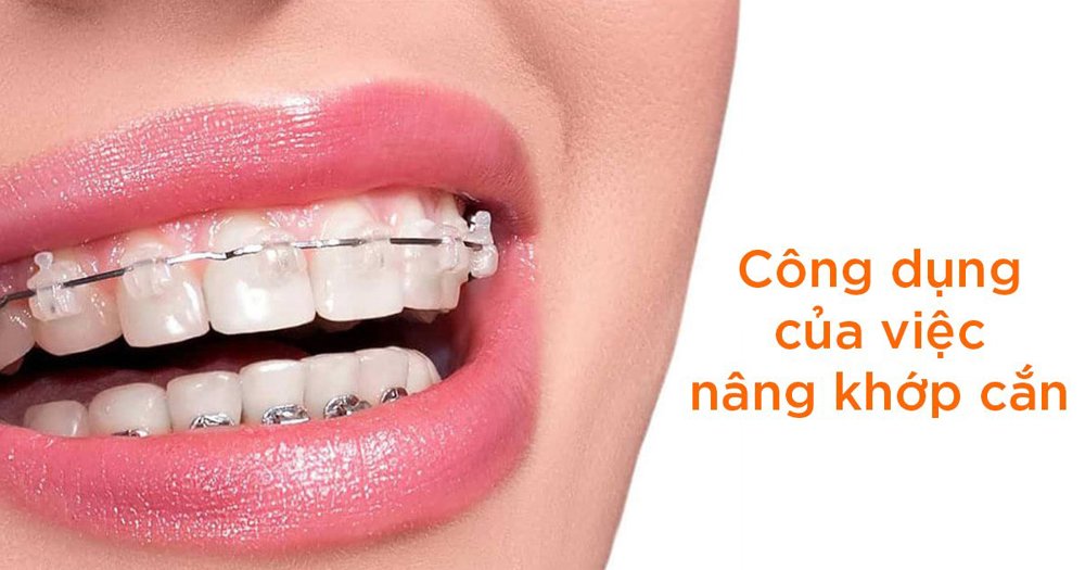 Công dụng của việc nâng khớp cắn