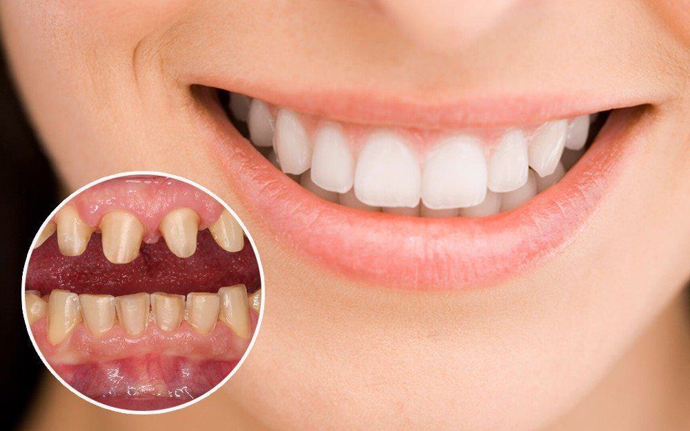 Vì sao răng thưa? Nguyên nhân và cách khắc phục