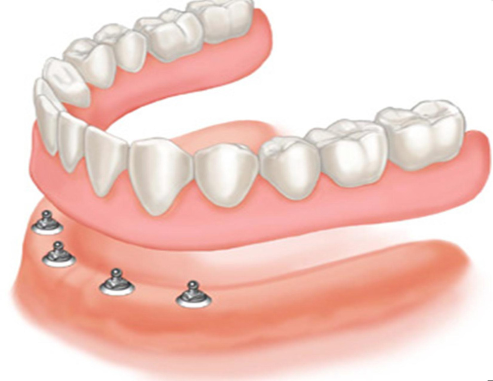 Hàm tháo lắp là gì? 5 thông tin quan trọng bạn cần biết