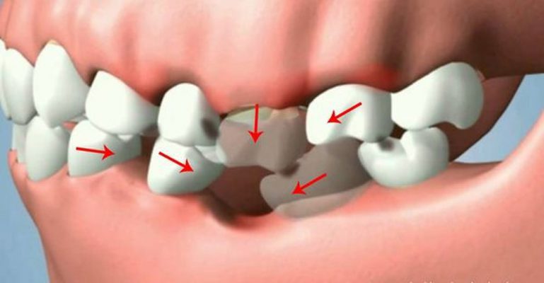 Răng số 6 là răng nào? Vai trò và hậu quả khi mất răng số 6