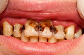 Nguyên nhân , triệu chứng , hậu quả, cách phòng ngứa và điều trị RĂNG SỮA bị sâu 
