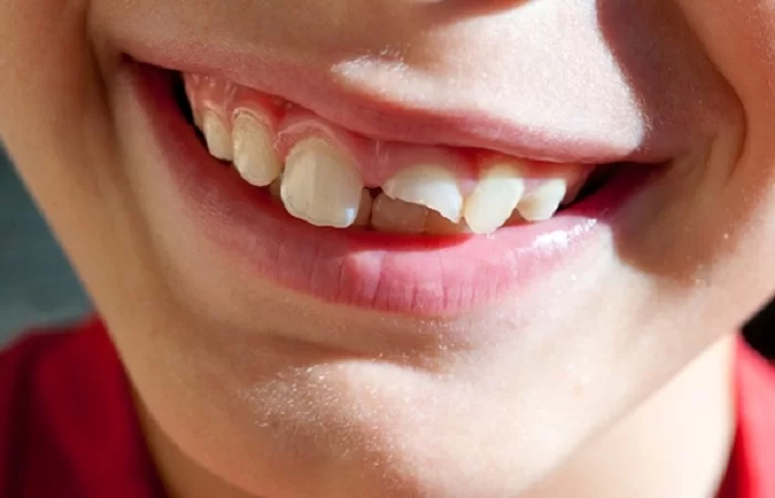 Răng bị gãy có ảnh hưởng gì không?