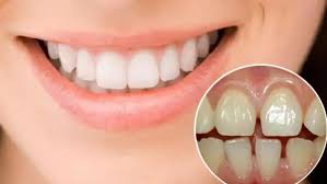 Kiến thức cơ bản về Bọc răng sứ 