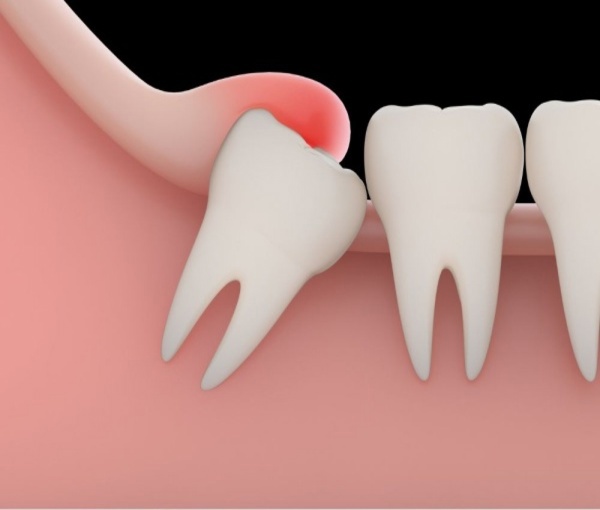Nguyên nhân nướu răng sưng và cần làm gì để nhanh khỏi? 