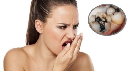 Sâu răng có gây hôi miệng không? Cách điều trị như thế nào?