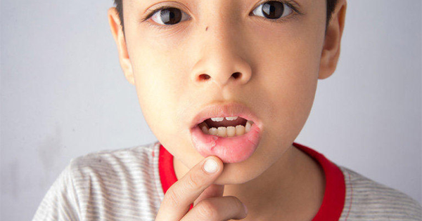 Trẻ em bị nhiệt miệng thì phải làm sao?