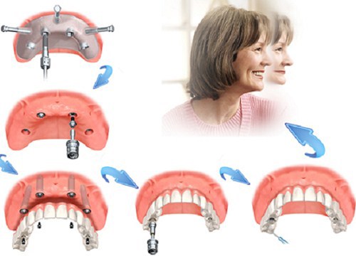 Người Già Có Cấy Implant Được Không?