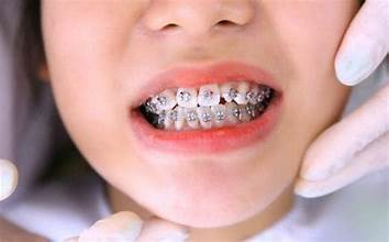 Giải đáp: Niềng răng có giữ được răng khểnh không?