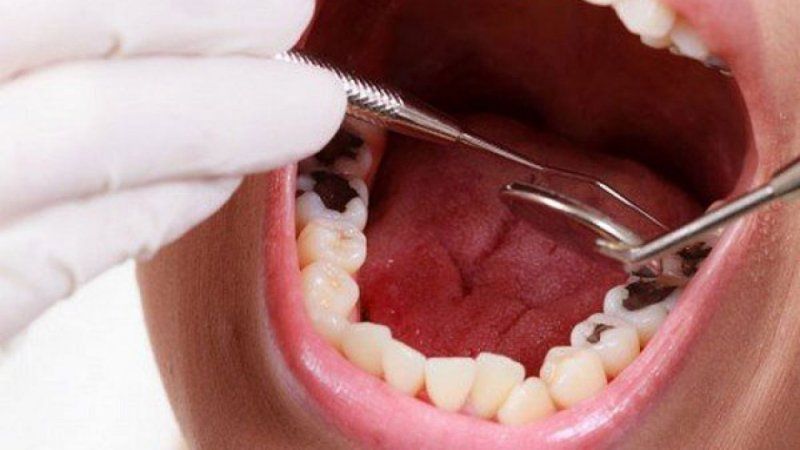 Trám răng sâu lỗ to có được không? 