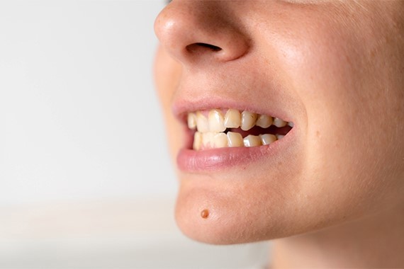 Khớp cắn đối đầu là gì? Nguyên nhân và cách khắc phục
