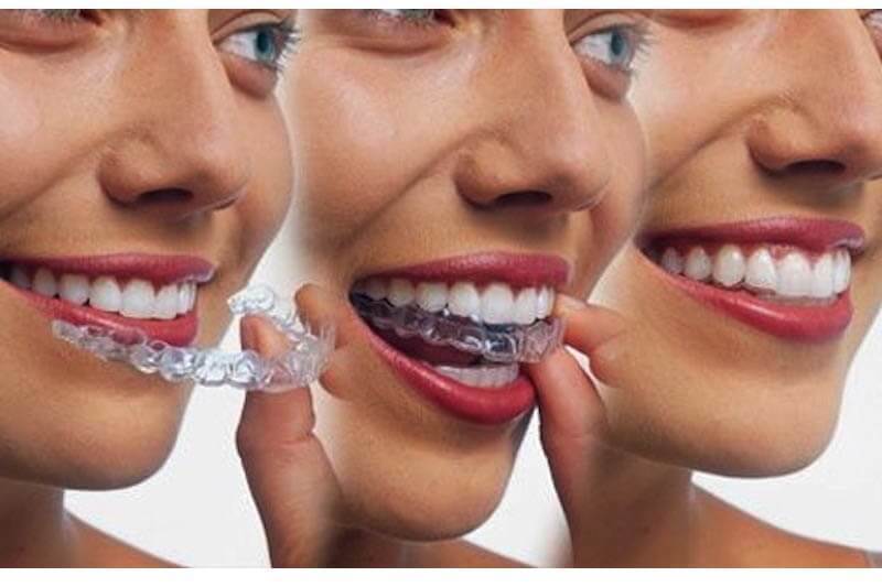 Sử Dụng Hàm Giả Tháo Lắp Có Bị Tiêu Xương Hàm Không