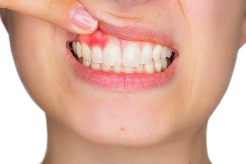 Tác Hại Của Bệnh Nha Chu