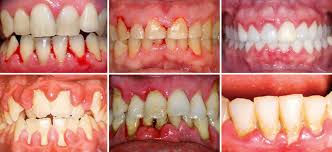 Bệnh nha chu có lây hay di truyền không?