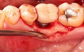 Viêm quanh Implant – Nguyên nhân và cách xử lý