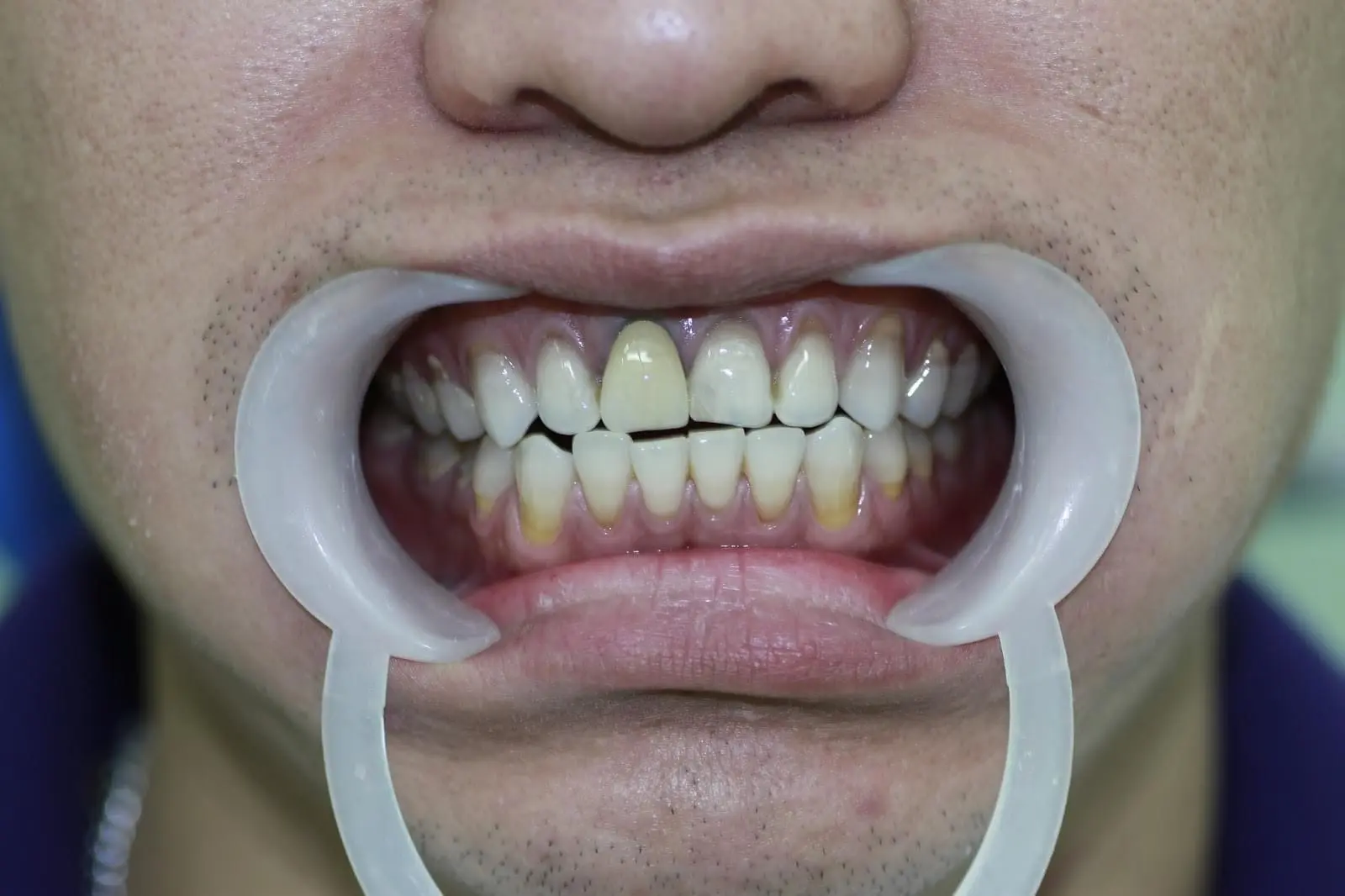 Bọc răng sứ bị đen nướu do đâu? Nên làm gì để khắc phục?
