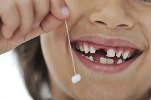 Trẻ bị gãy răng sữa có mọc lại không? Cha mẹ nên xử trí thế nào?