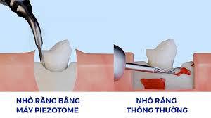 Nhổ Răng Bằng Máy Siêu Âm Có Tốt Không?