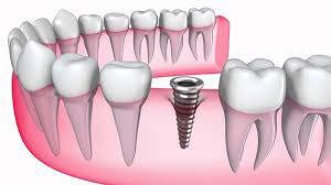 Nhổ Răng Hư Có Trồng Răng Implant Được Không?
