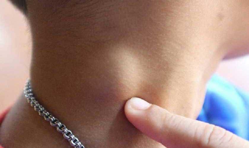 Viêm nướu răng nổi hạch có nguy hiểm không?