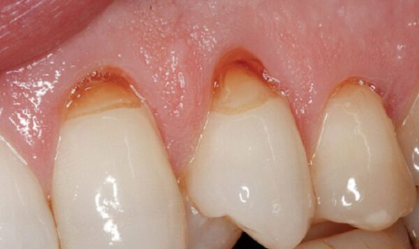 Khuyết Cổ Răng Là Bị Gì?