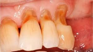 Nguyên Nhân Và Cách Điều Trị Khuyết Cổ Răng Hiệu Quả Nhất Hiện Nay