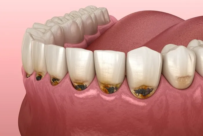 Trám Khuyết Cổ Răng Bao Lâu Xong?