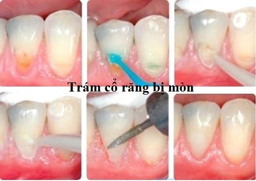 Bệnh Khuyết Cổ Chân Răng Có Sao Không?