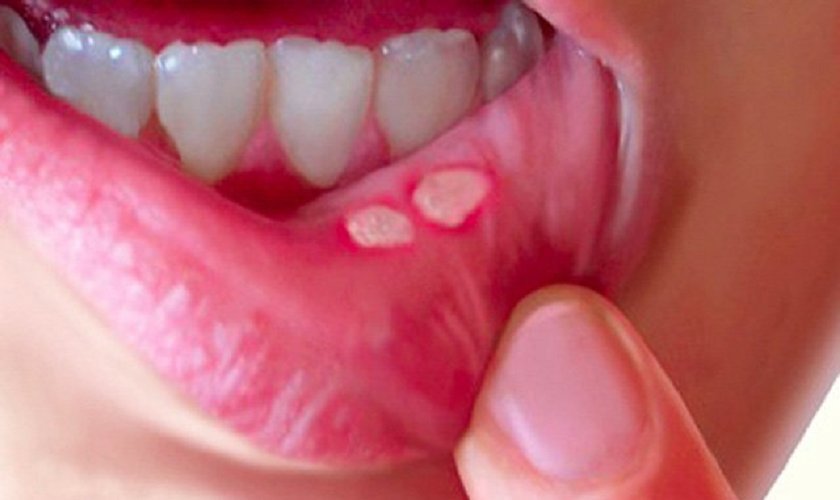 Vì Sao Chúng Ta Thường Bị Nhiệt Miệng?