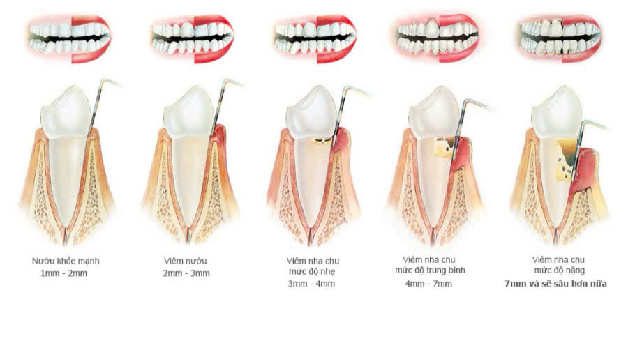 Răng Lung Lay Có Giữ Lại Được Không?