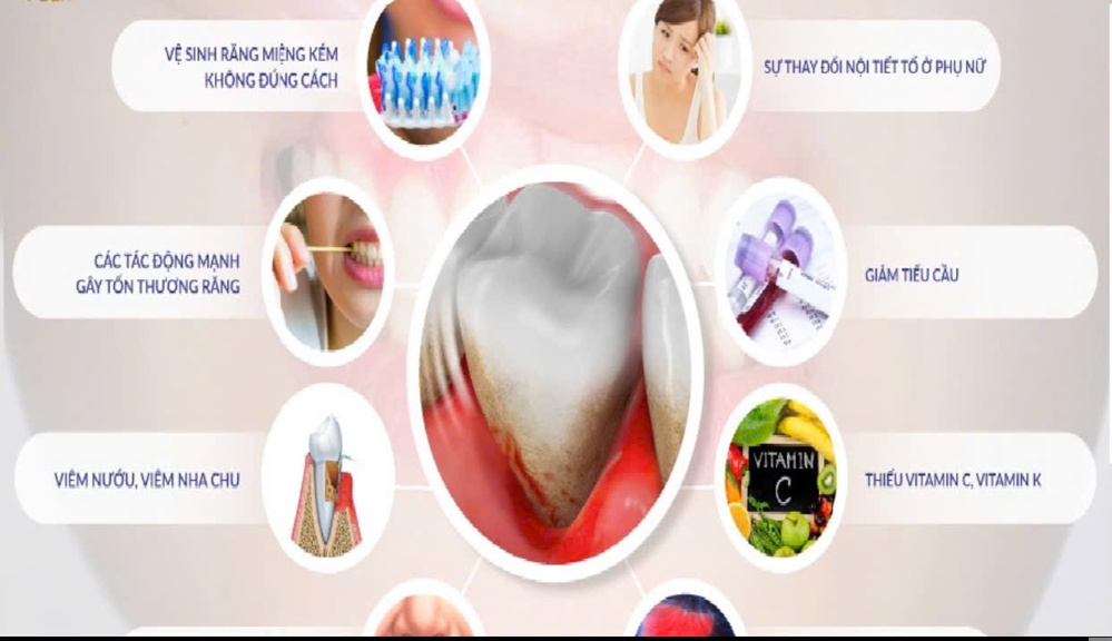 10 Nguyên Nhân Chính Gây Chảy Máu Chân Răng Và Cách Điều Trị 