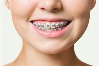 Quy trình niềng răng đầy đủ và chi tiết nhất