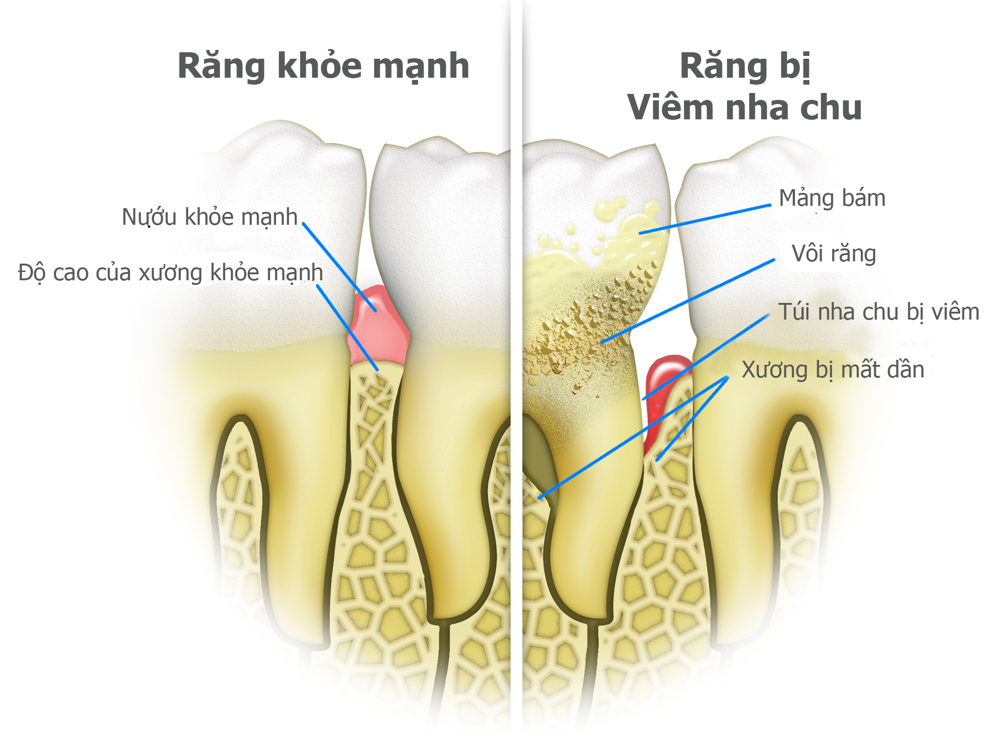 Tác Hại Của Bệnh Nha Chu