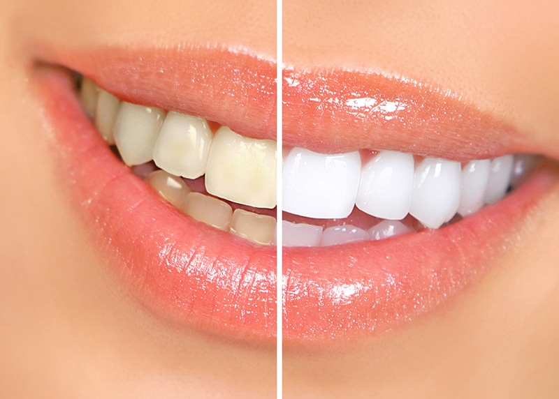 Cách Tẩy Trắng Răng Bằng Muối Nabica Cực Đơn Giản?
